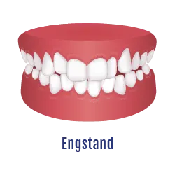 Engstand Zahnfehlstellung | Behandelbar mit dem Aligner