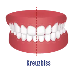 Kreuzbiss Zahnfehlstellung | Behandelbar mit dem Aligner