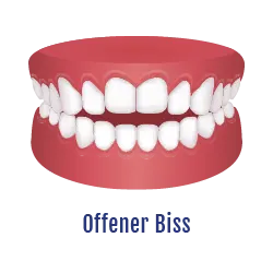 Offener Biss Zahnfehlstellung | Behandelbar mit dem Aligner