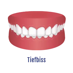 Tiefbiss Zahnfehlstellung | Behandelbar mit dem Aligner
