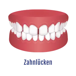 Zahnlücken Zahnfehlstellung | Behandelbar mit dem Aligner